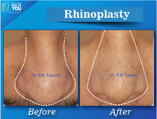 rhinoplasty surgery result